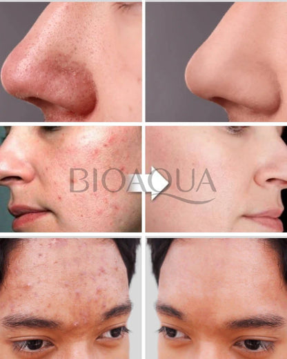 PACK ANTIACNE BIOAQUA